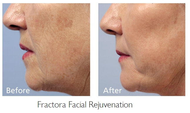 Fractora Facial Rejuvenation