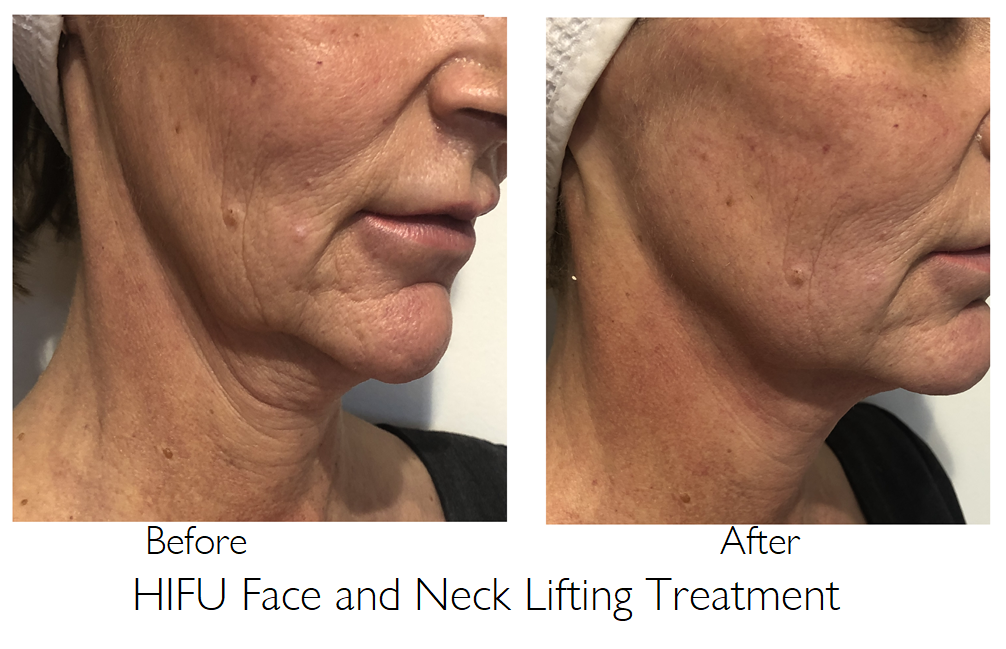 Hifu face and neck lifting