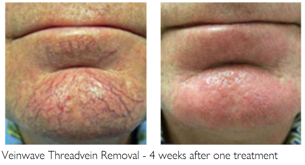Veinwave Thread vein Removal House of Beauty